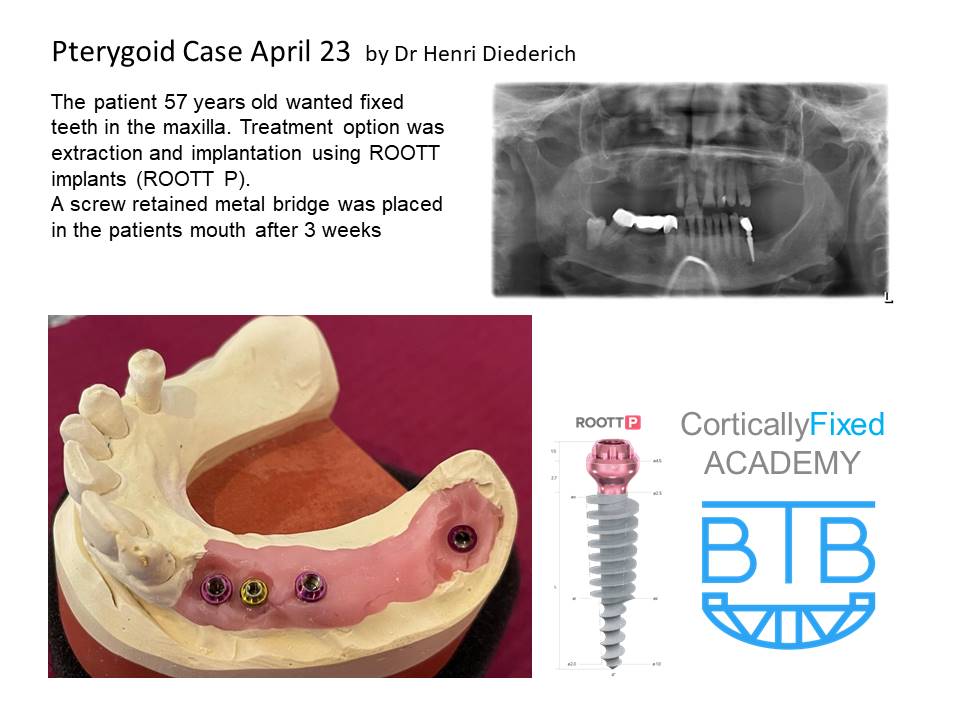 Pterygoid Implant application