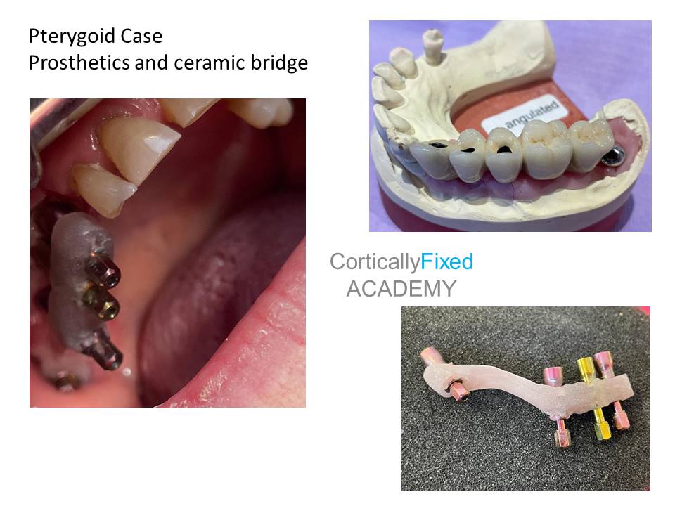 Pterygoid Implant application