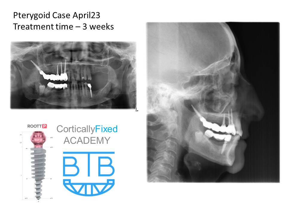 Pterygoid Implant application