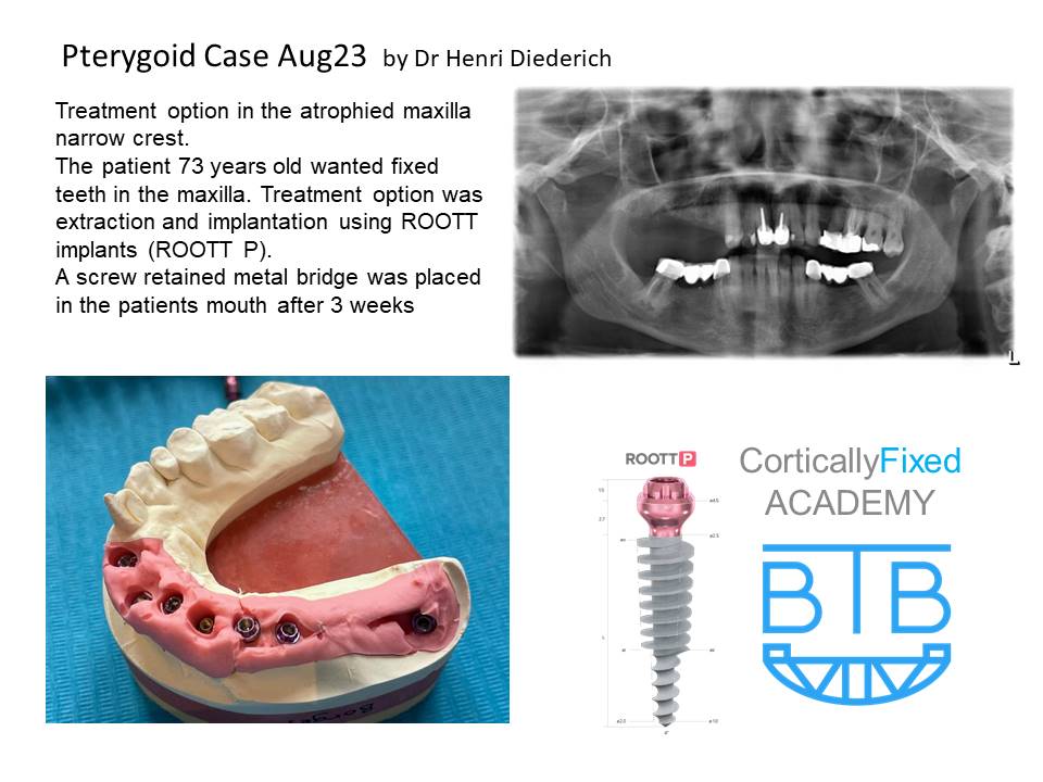 Pterygoid Implant application