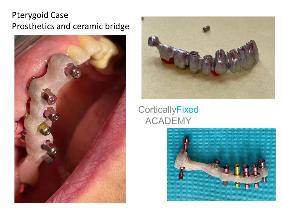 Pterygoid Implant application