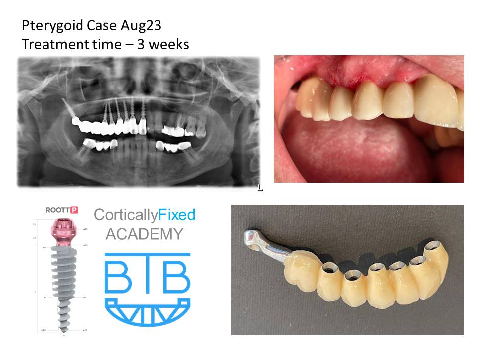 Pterygoid Implant application