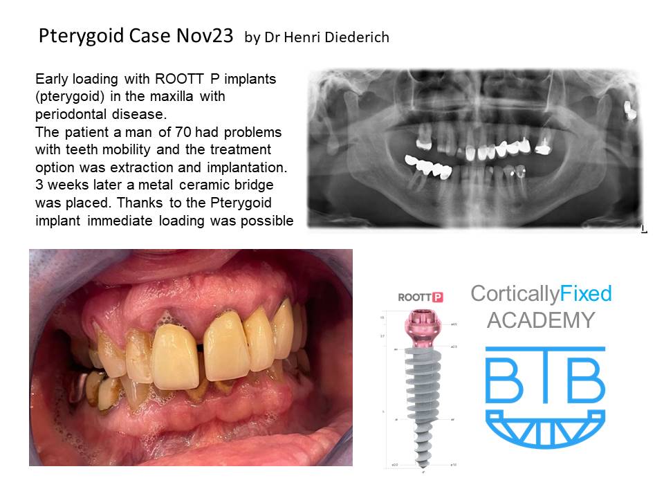 Pterygoid Implant application