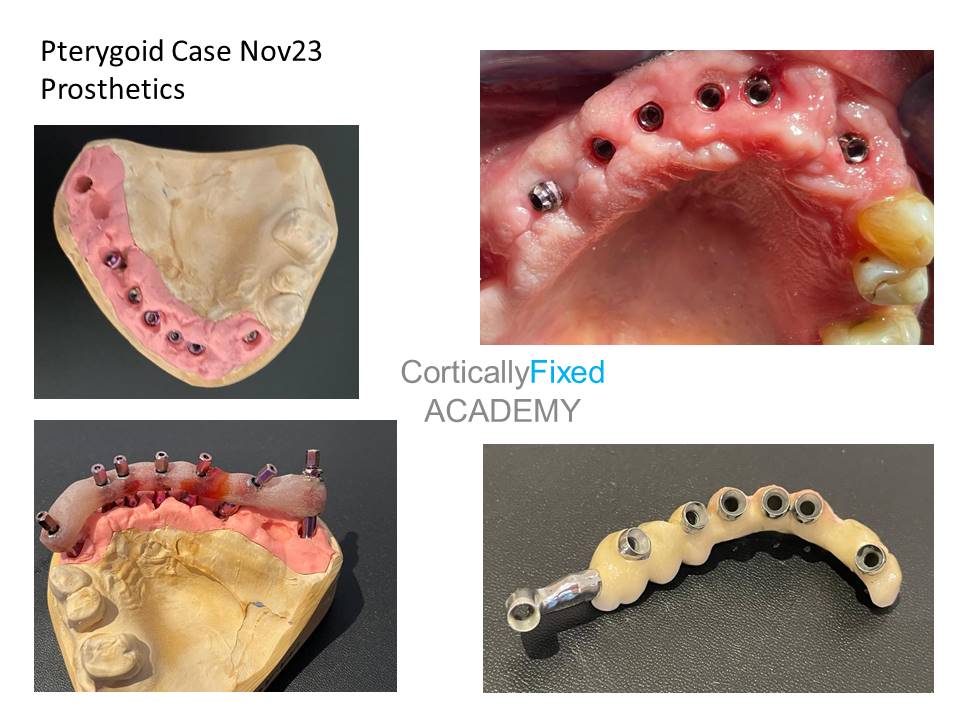 Pterygoid Implant application