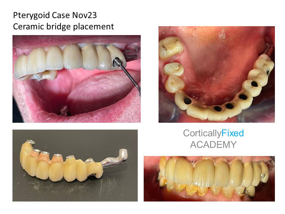 Pterygoid Implant application