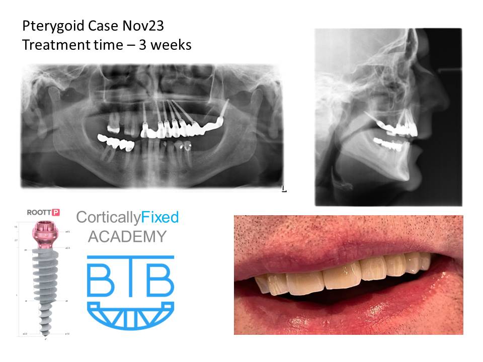 Pterygoid Implant application