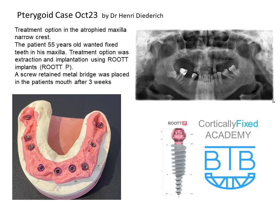 Pterygoid Implant application