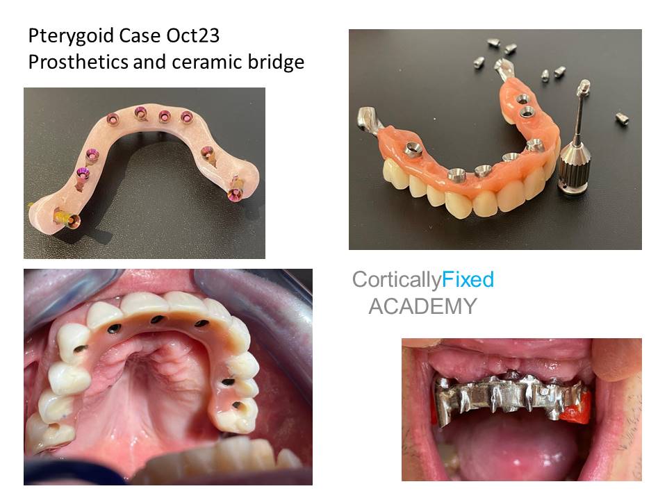 Pterygoid Implant application