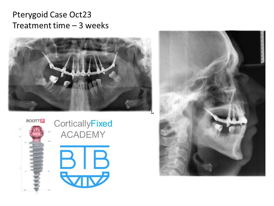 Pterygoid Implant application